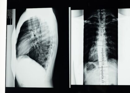 High-resolution X-ray showing a detailed examination of human spine with scoliosis.