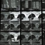 Multiple spinal x-ray and CT scan images displayed together, illustrating the medical evaluation process for scoliosis back braces