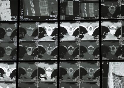Multiple spinal x-ray and CT scan images displayed together, illustrating the medical evaluation process for scoliosis back braces